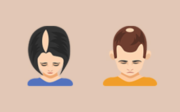 남성형 탈모, 여성형 탈모